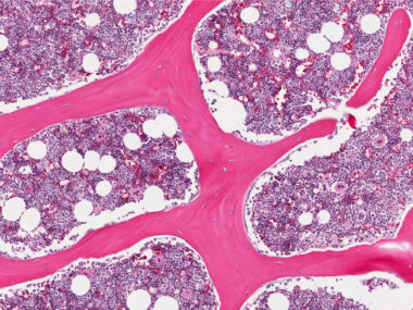 Bone marrow cells and multiple myeloma.