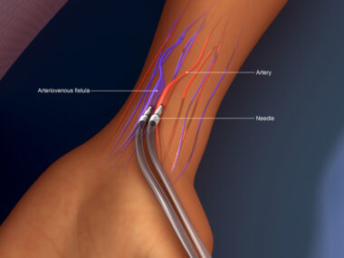 Blood Purification Technique for Multiple Myeloma