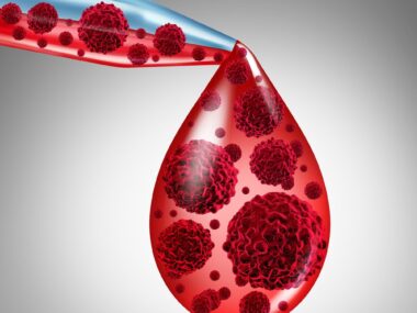 stem cell transplant, PNK-007, myeloma