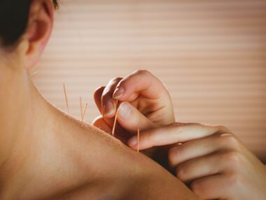 acupuncture