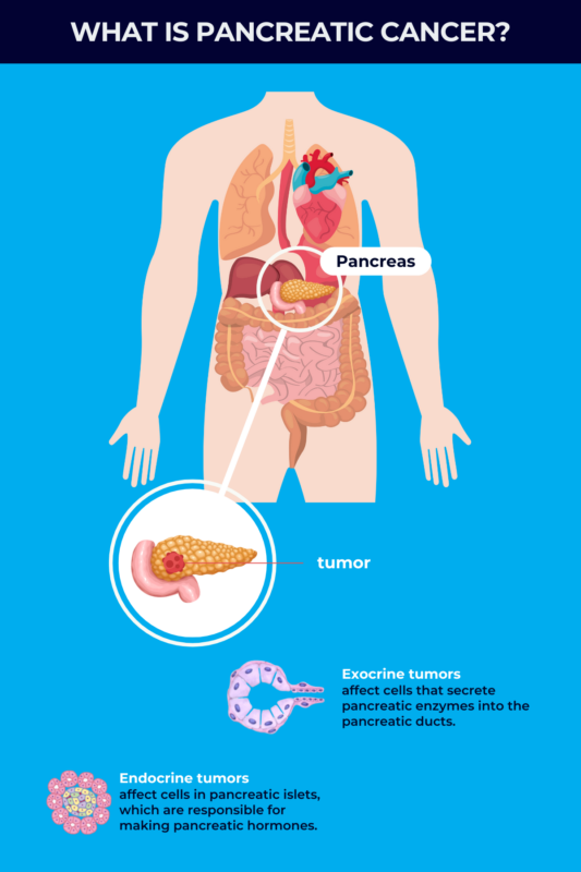 Infographic about pancreatic cancer