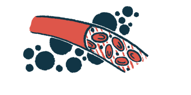 An illustration shows a blood vessel.